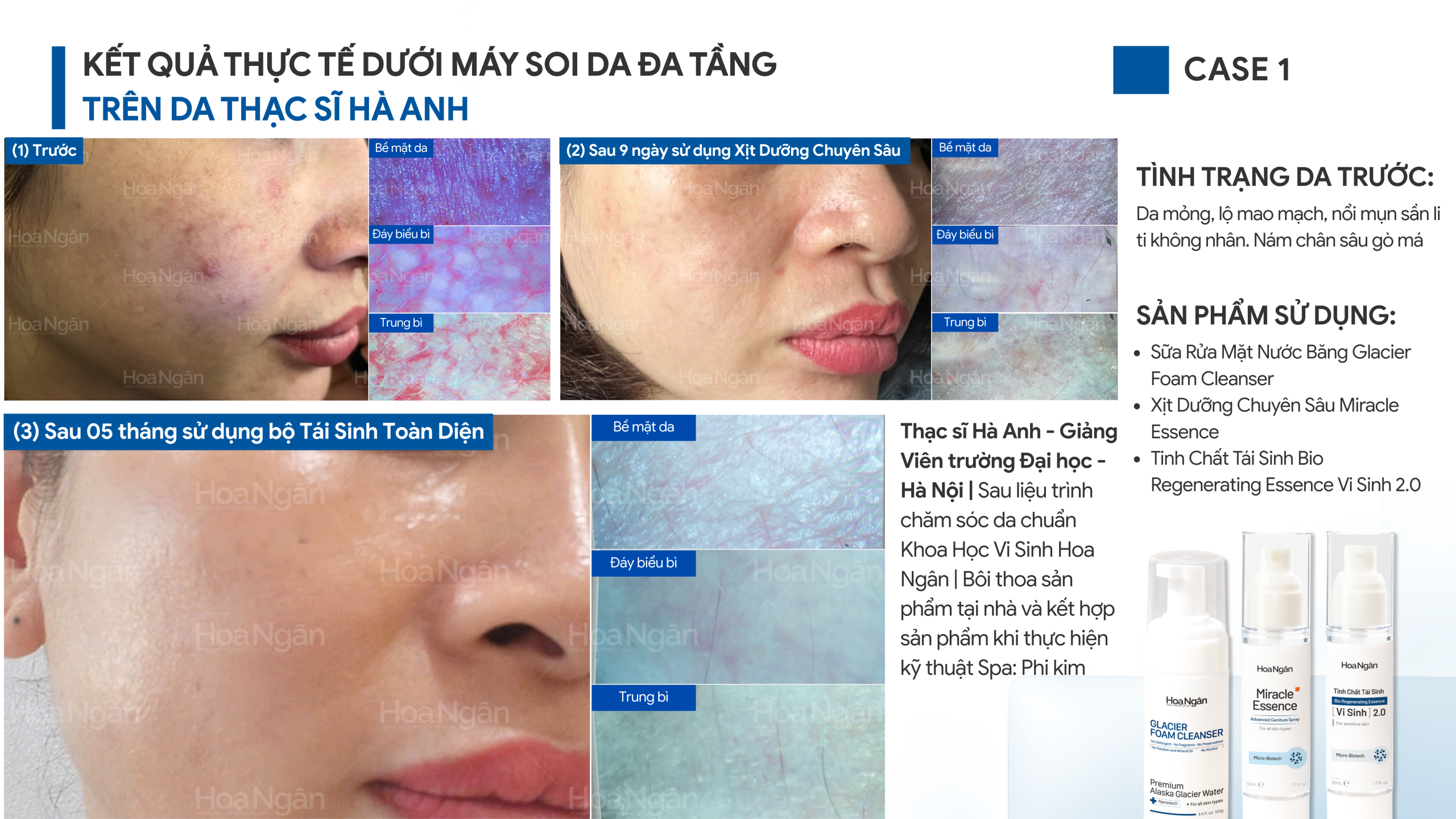 Ảnh gốc: da mỏng yếu, lộ mao mạch; các mốc trước sử dụng, sau 9 ngày và sau 5 tháng