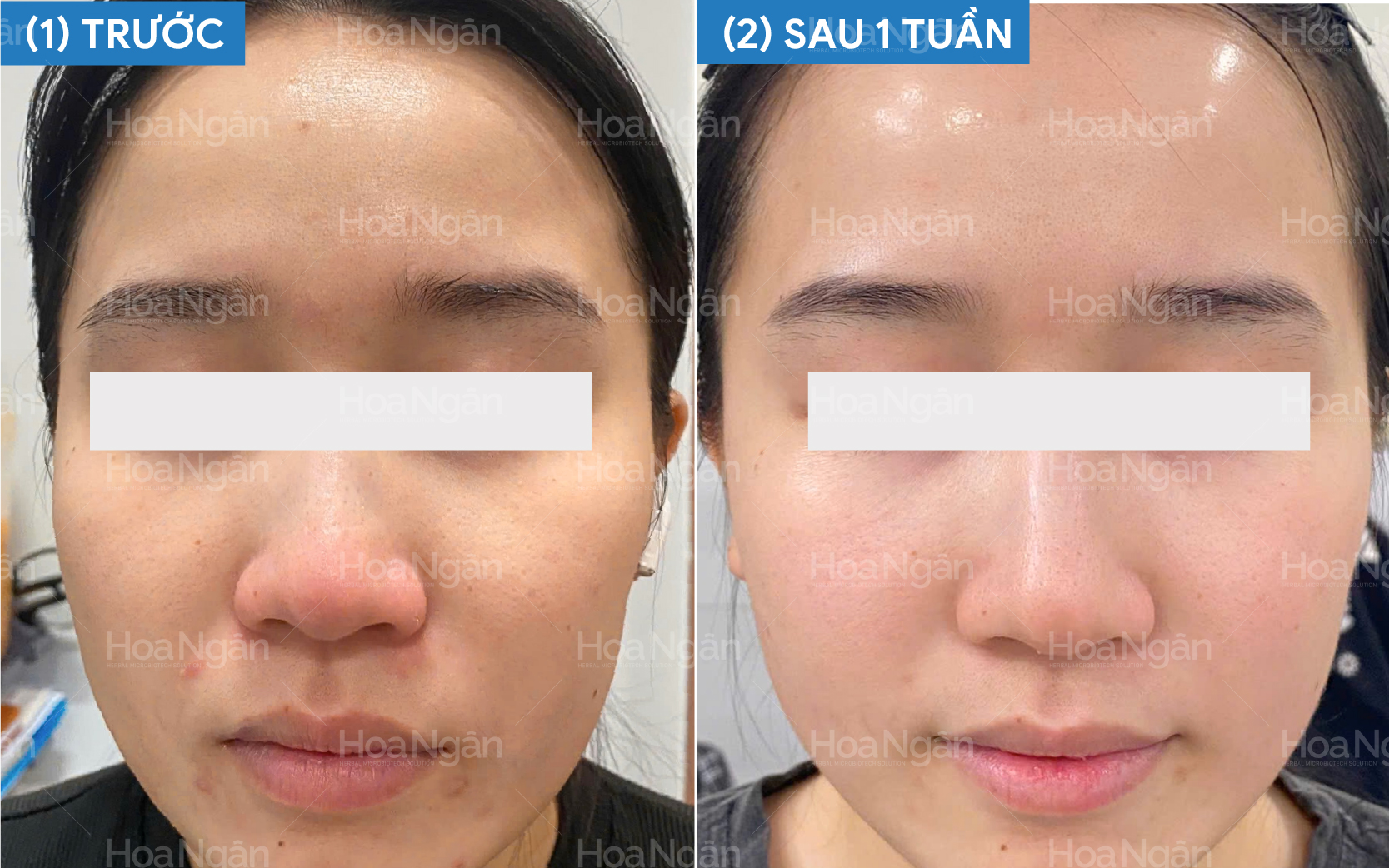 Cải thiện mụn và thâm mụn sau 7 ngày