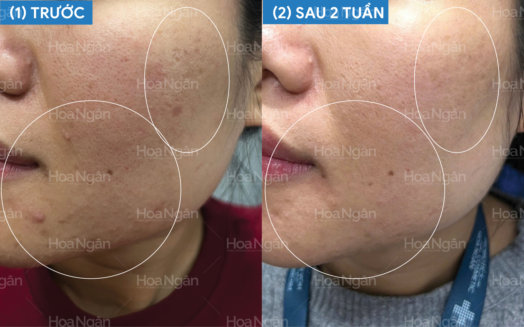 Cải thiện mụn ẩn, thâm – Da mẹ bầu