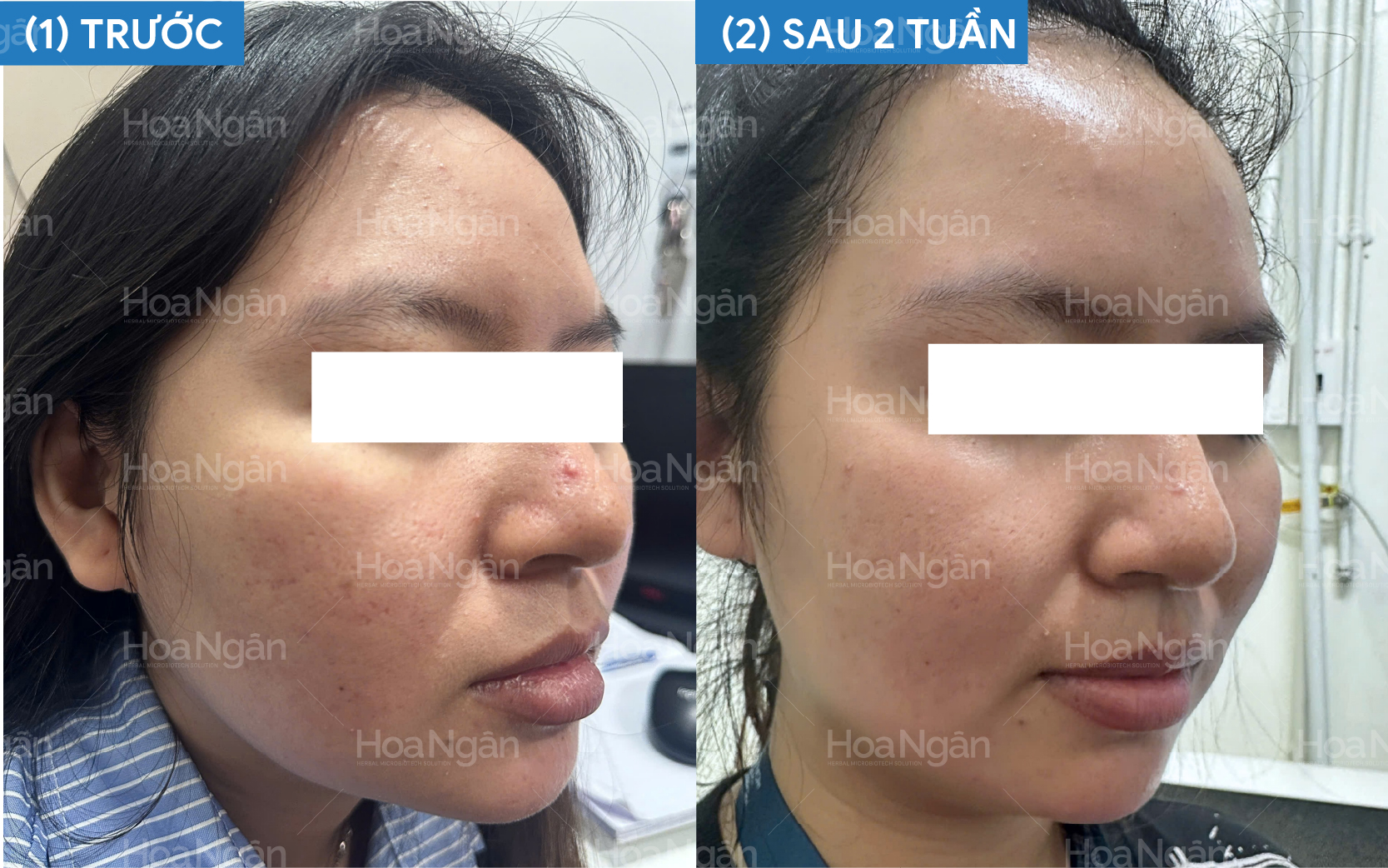 Dầu nhờn, độc tố dưới da và mụn ẩn nhiều