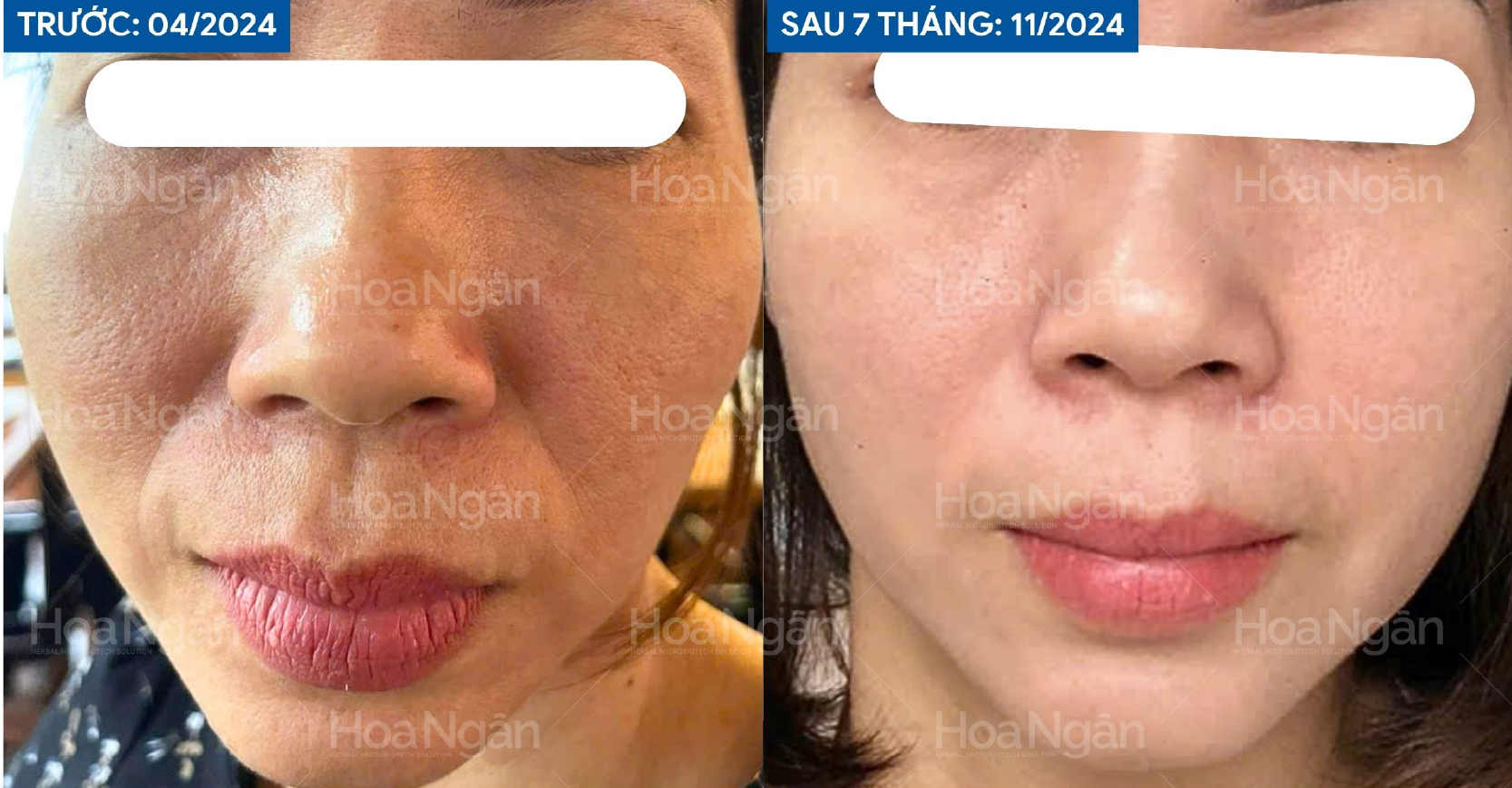 Nếp nhăn rãnh cười, chảy xệ, lỗ chân lông to