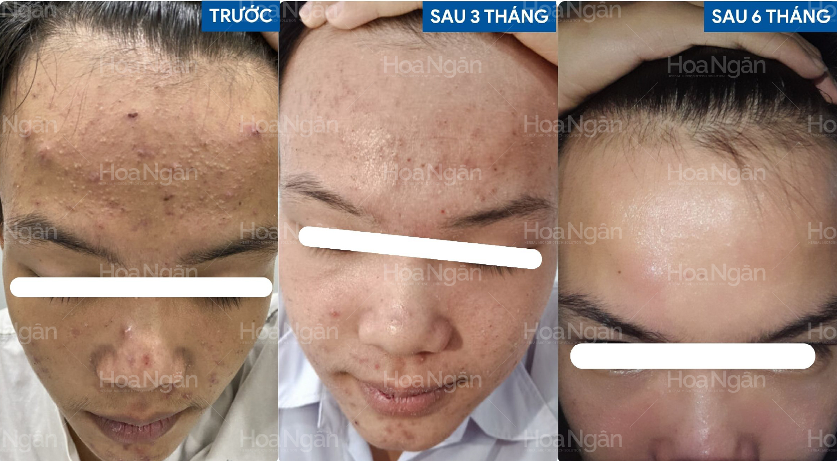 Da mụn tuổi dậy thì