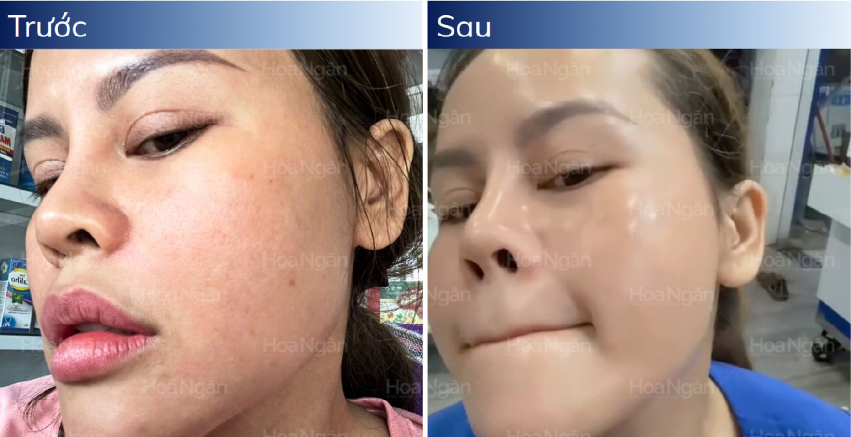 Kết quả trước sau bước 3