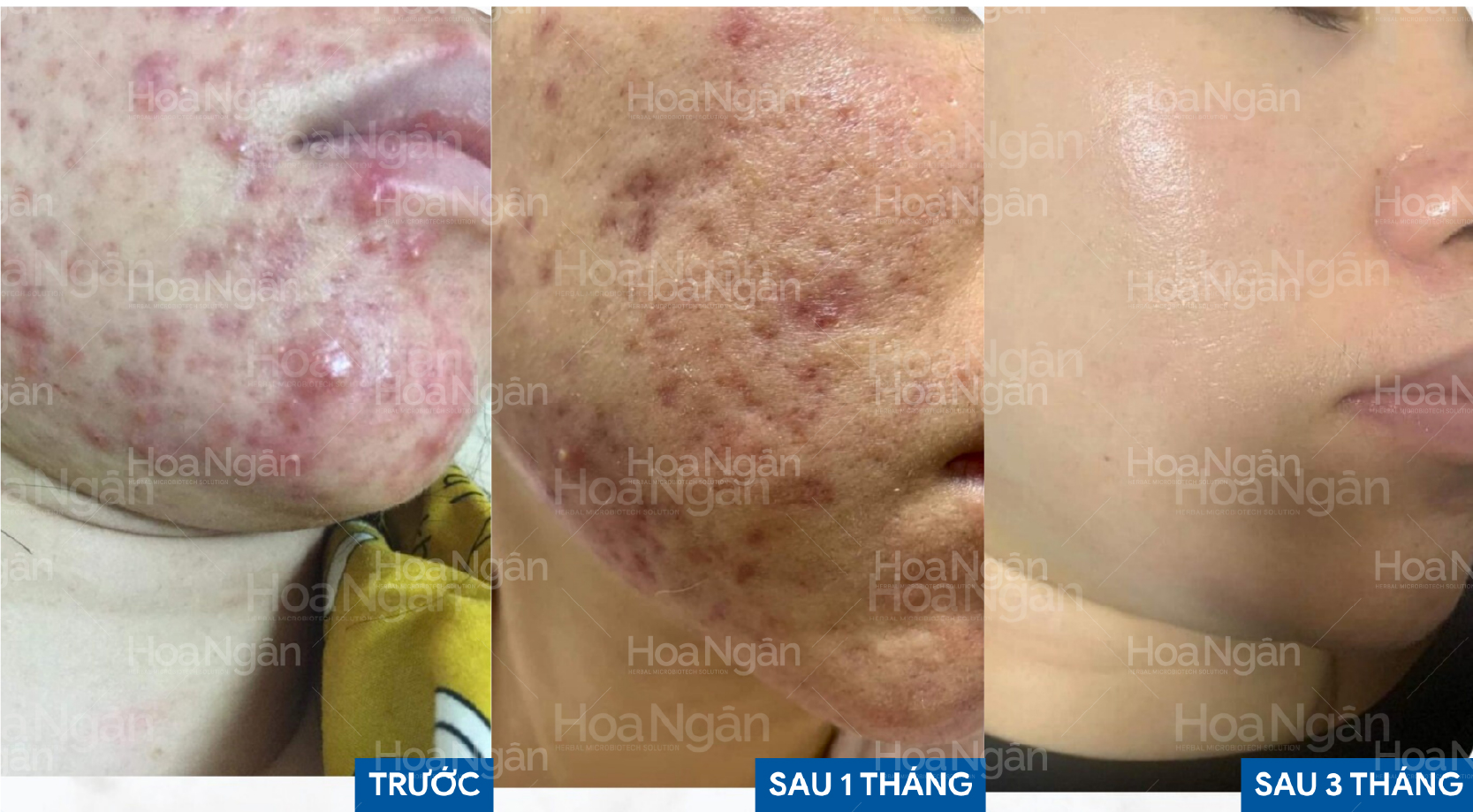 Kết quả trên da mụn nội tiết