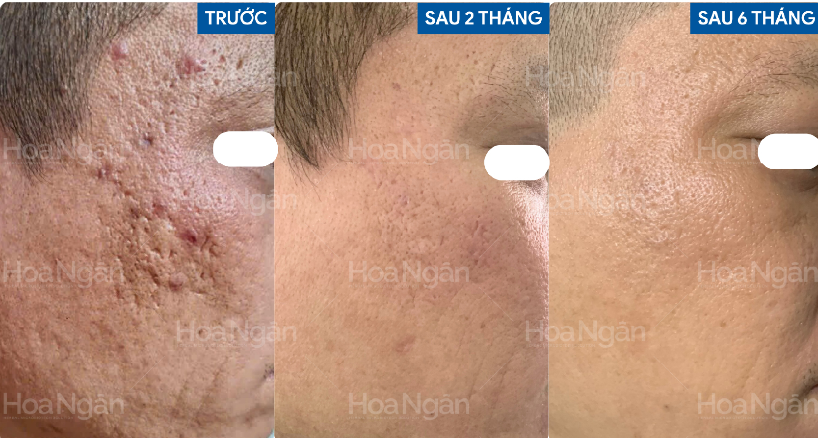 Da sẹo rỗ lâu năm, nếp nhăn sâu