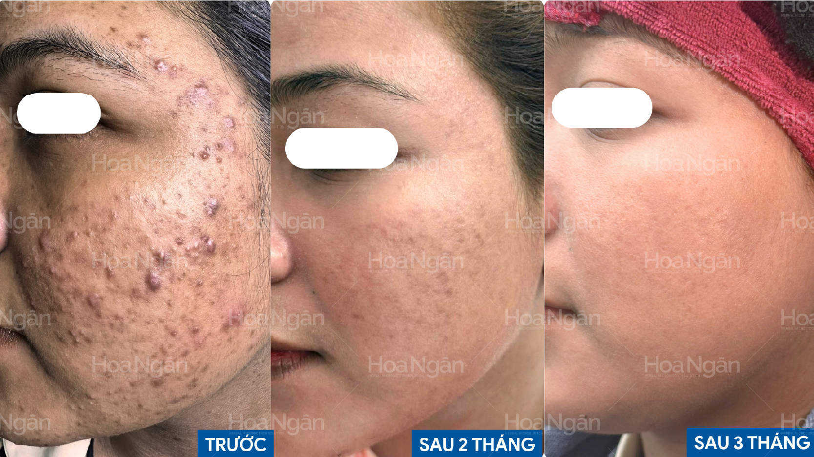 Kết quả thực tế trên da mụn nội tiết