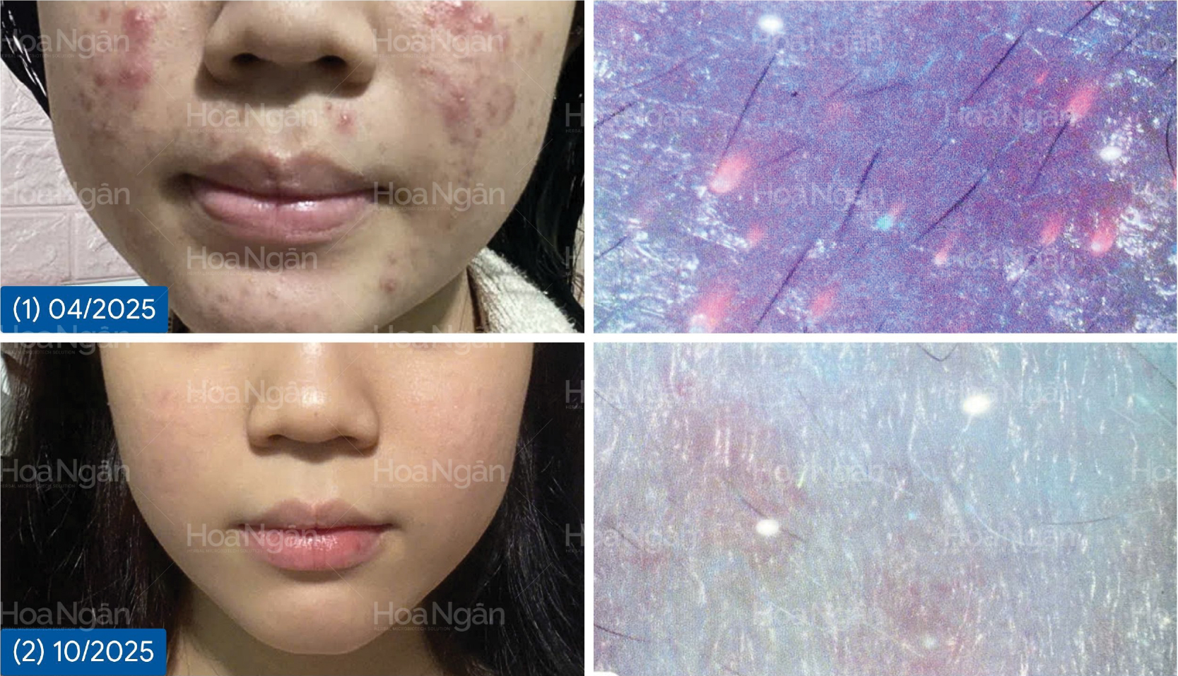 Da mụn dậy thì, mụn viêm sưng đỏ