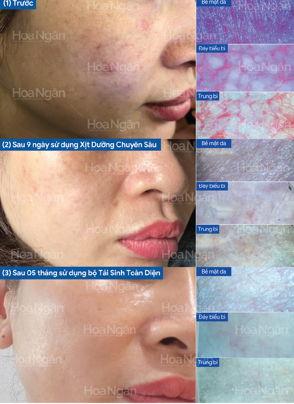 Kết quả thực tế dưới máy soi đa tầng trên da mỏng yếu mụn sần li ti