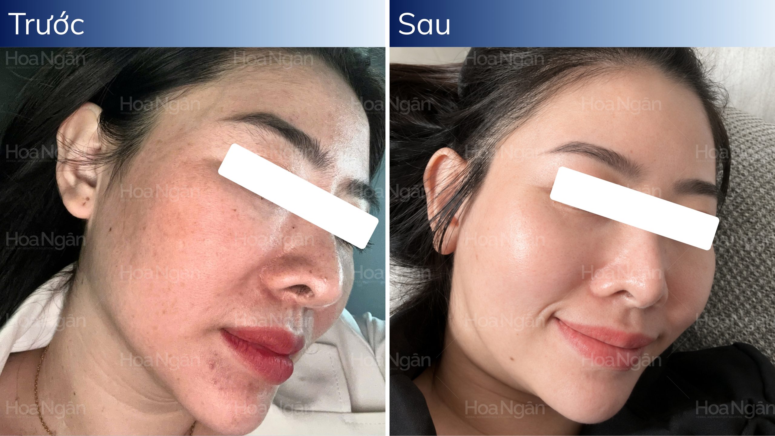 Kết quả thực tế da thâm sạm, nhiều tắc nghẽn, sần sùi