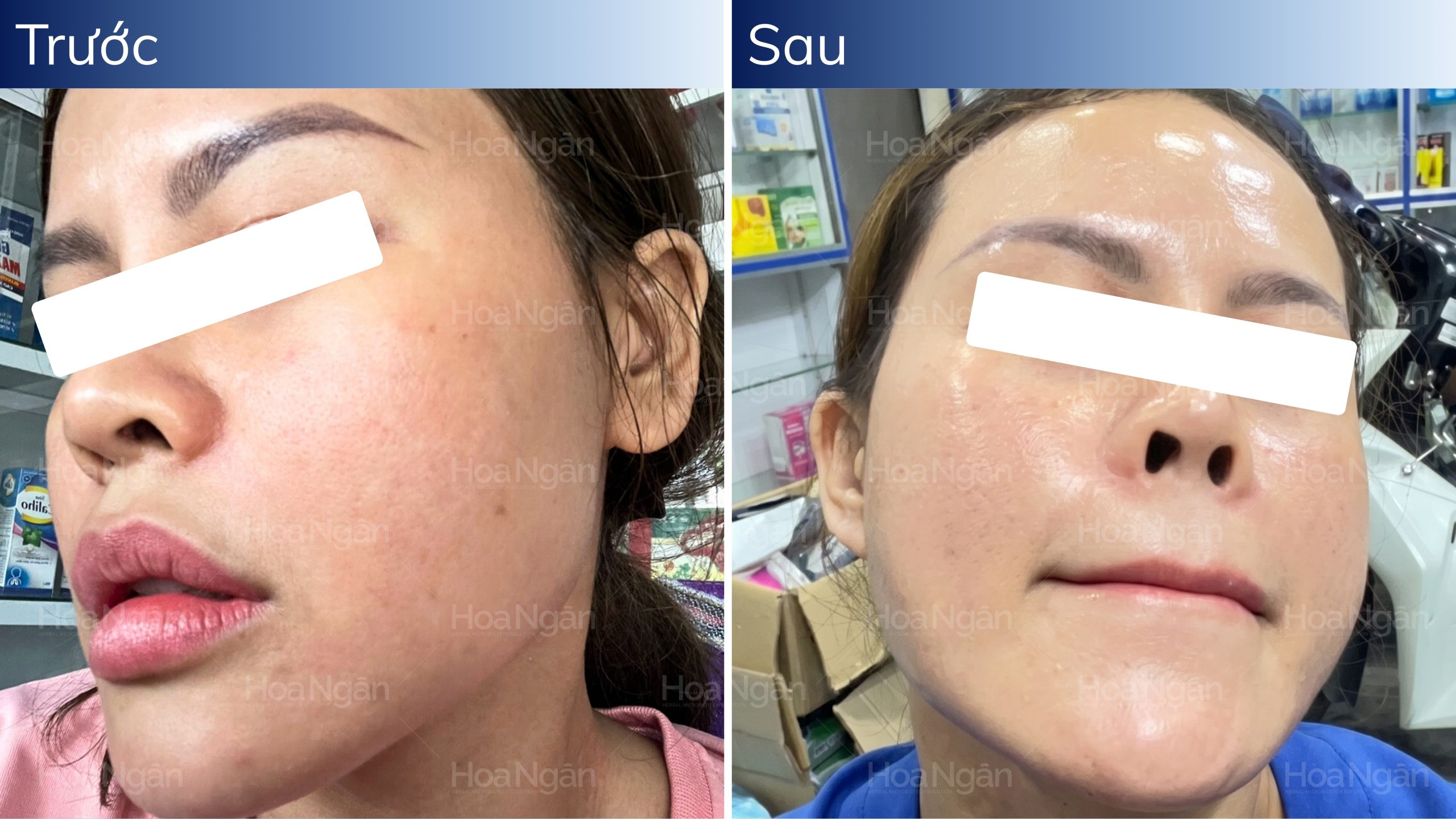 Kết quả thực tế da mụn tắc nghẽn, lỗ chân lông to, sần sùi