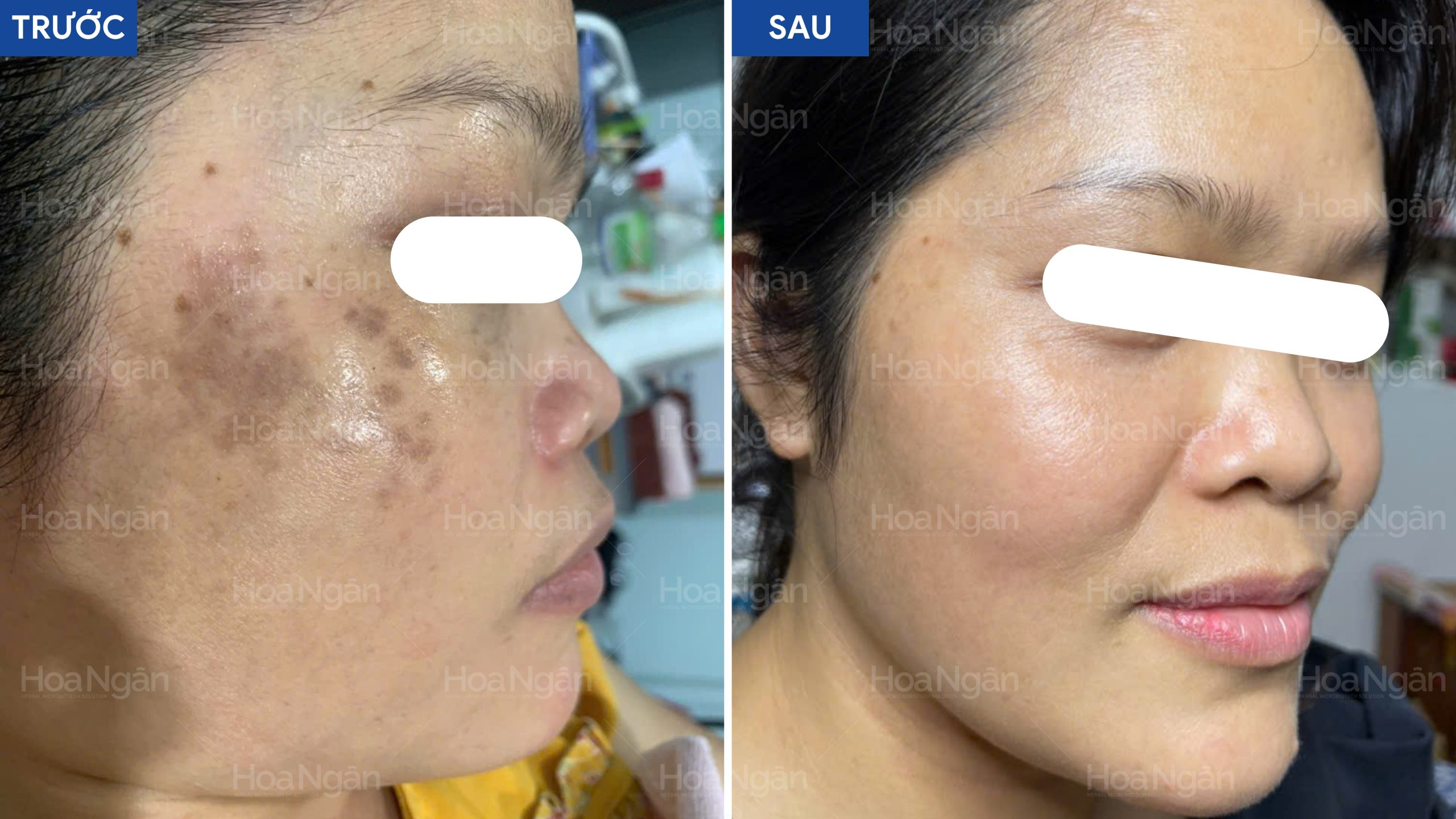 Kết quả thực tế trên da nám chân sâu lâu năm Hoa Ngân